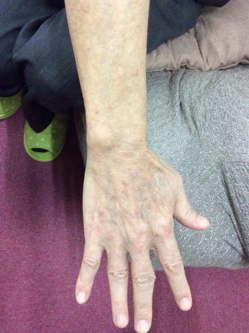 アトピー治療